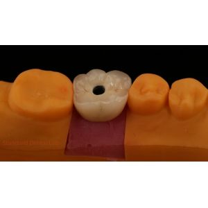 China Screw Retained PFZ Porcelain Layered Zirconia Dental Implant Crown from Dental Lab ISO FDA CE Certified with 5-Year Guarantee on sale