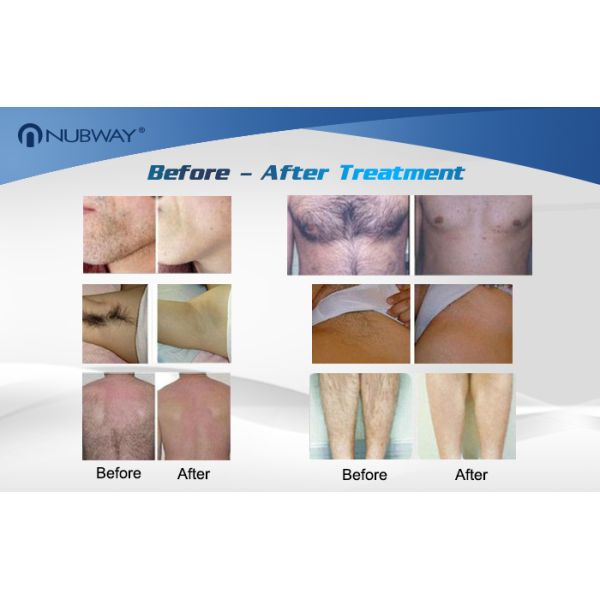 600w Dilas Laser Diode Depilation Device , 808nm Laser Diode Hair Removal Machine