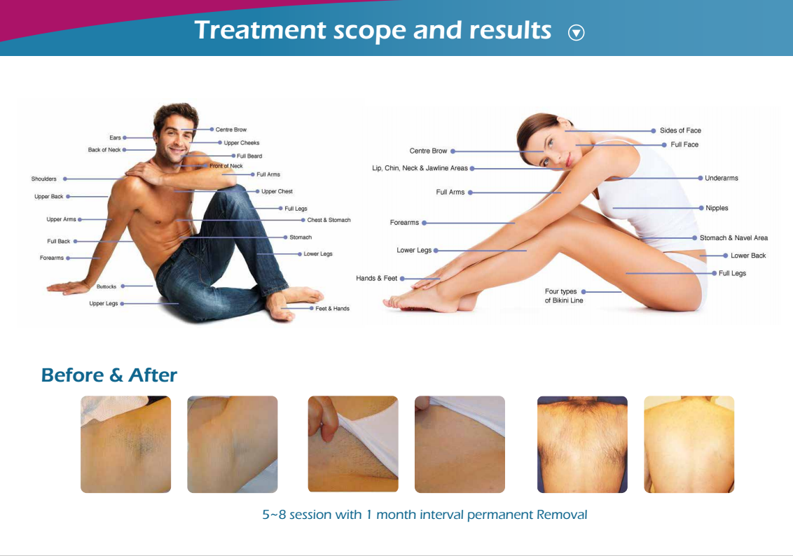 Intense laser pulse output,high performance on result,painless treatment,Portable Diode Laser Hair Removal Machine