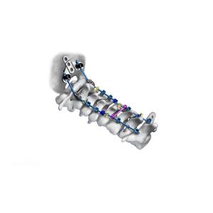 China 40mm - 100mm CrCoMo Pedicle Screw Cervical Spinal Fusion System wholesale