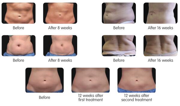 5 treatment handles cold shape cryolipolysis fat freeze slimming machine with amazing results