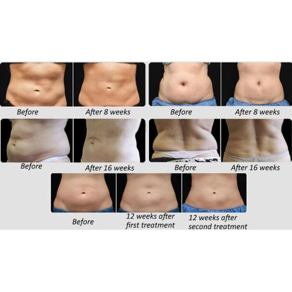 Europe popular 4 handpieces Cryomed Cryolipolysis RF Cool Shaping Slimming Machine