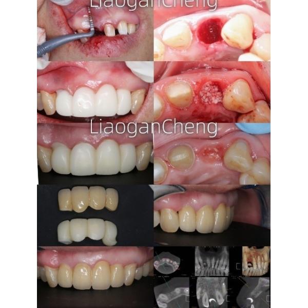 Multilayered Gradient Technology Dental Zirconia Safe And Aesthetically Pleasing