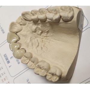 China Metal Ceramic Good Fitness PFM Dental Crown wholesale