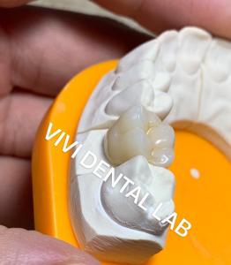China Solid Dental Lab Crowns 3D Pro High Translucency Full Zirconia Crowns China Dental Lab wholesale